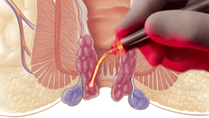 Tratamento para hemorroidas a laser: uma abordagem moderna e eficiente