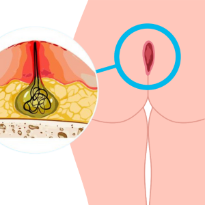 arte de cisto pilonidal Cisto Pilonidal