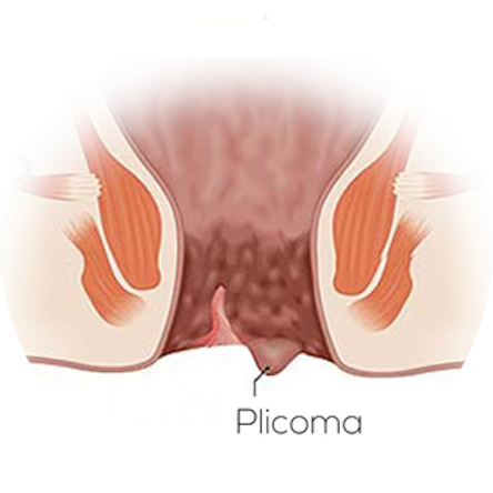 Plicoma Anal: o que é, causas, sintomas e tratamento 1 b51708 43e1d173a380404180e7794845c7bd15mv2 Plicoma Anal: o que é, causas, sintomas e tratamento