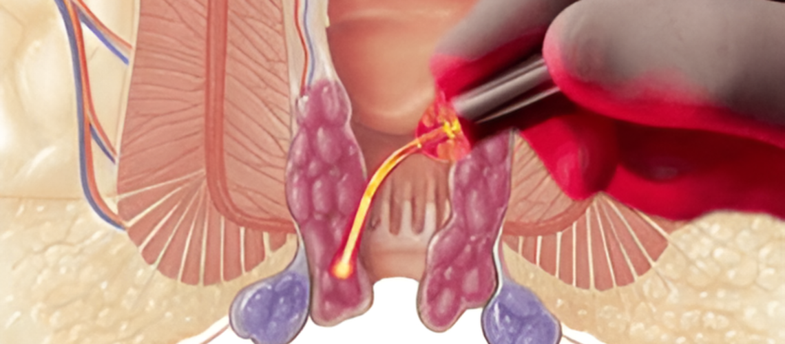 Tratamento para hemorroidas a laser: uma abordagem moderna e eficiente